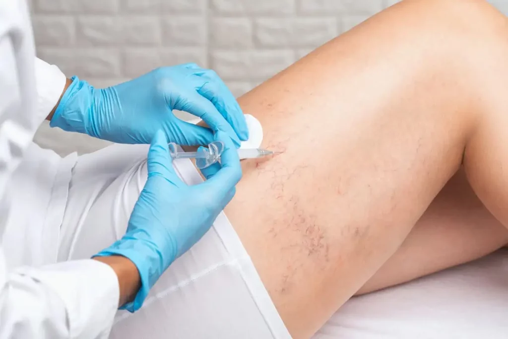 Sclerotherapy by The Best Injector in Delray Beach FL