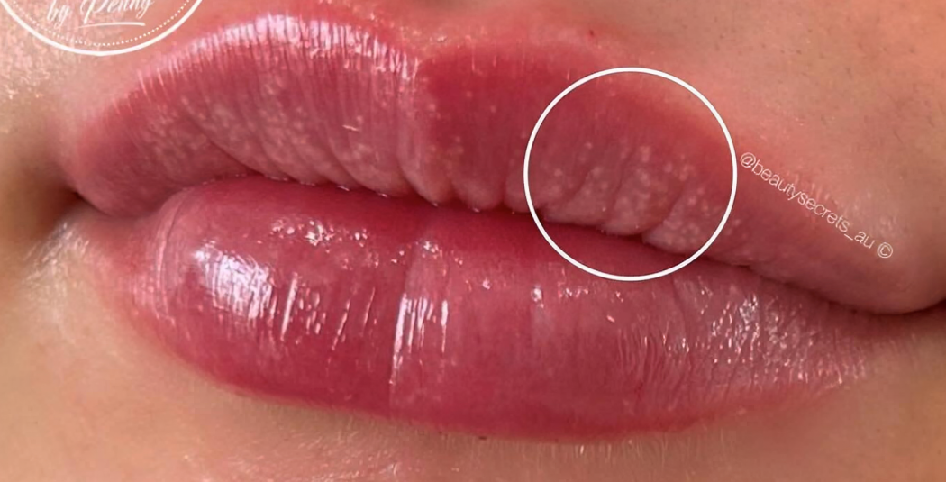 Lips filler 2