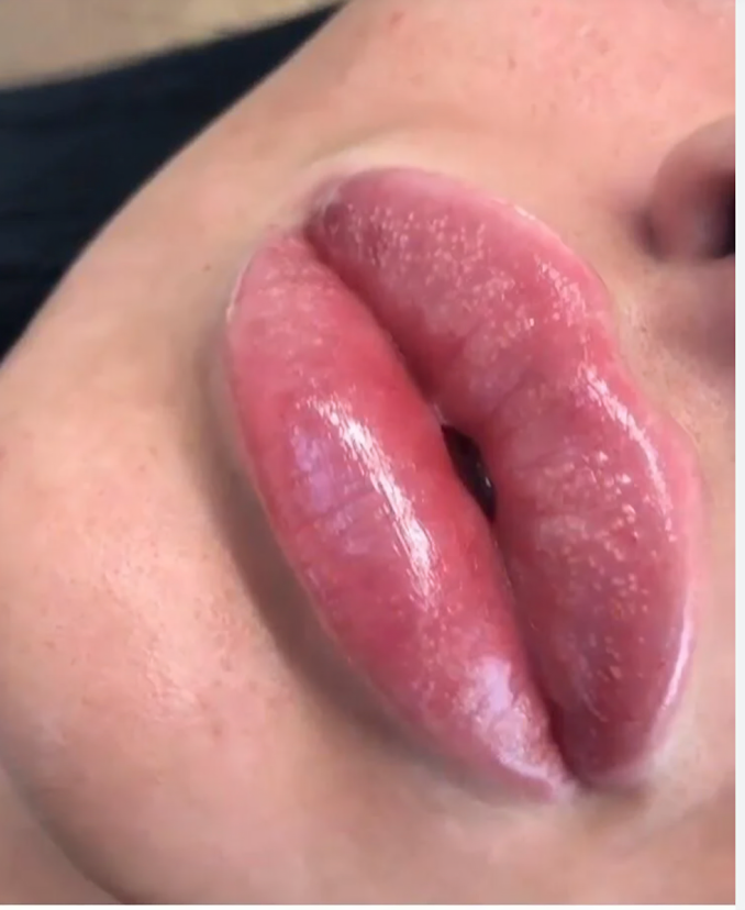 Lips Filler