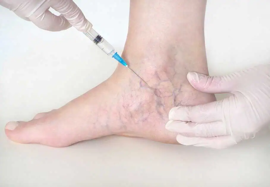 Sclerotherapy in Delray Beach, FL by The Best Injector