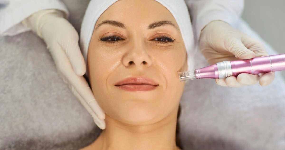 WomenreceivingMicroneedlinginDelrayBeachFL at The Best Injector