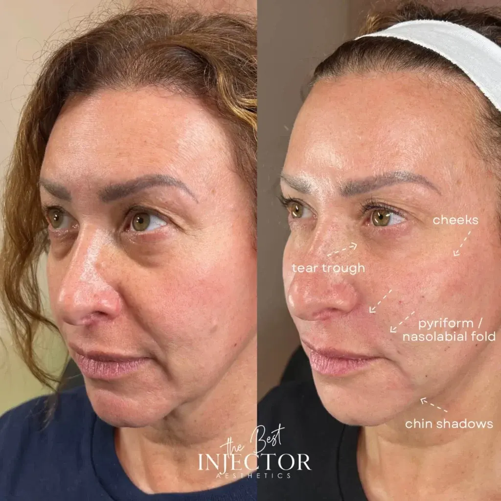 Balance-Your-Facial-Features-in-Delray-Beach-at-The-Best-Injector
