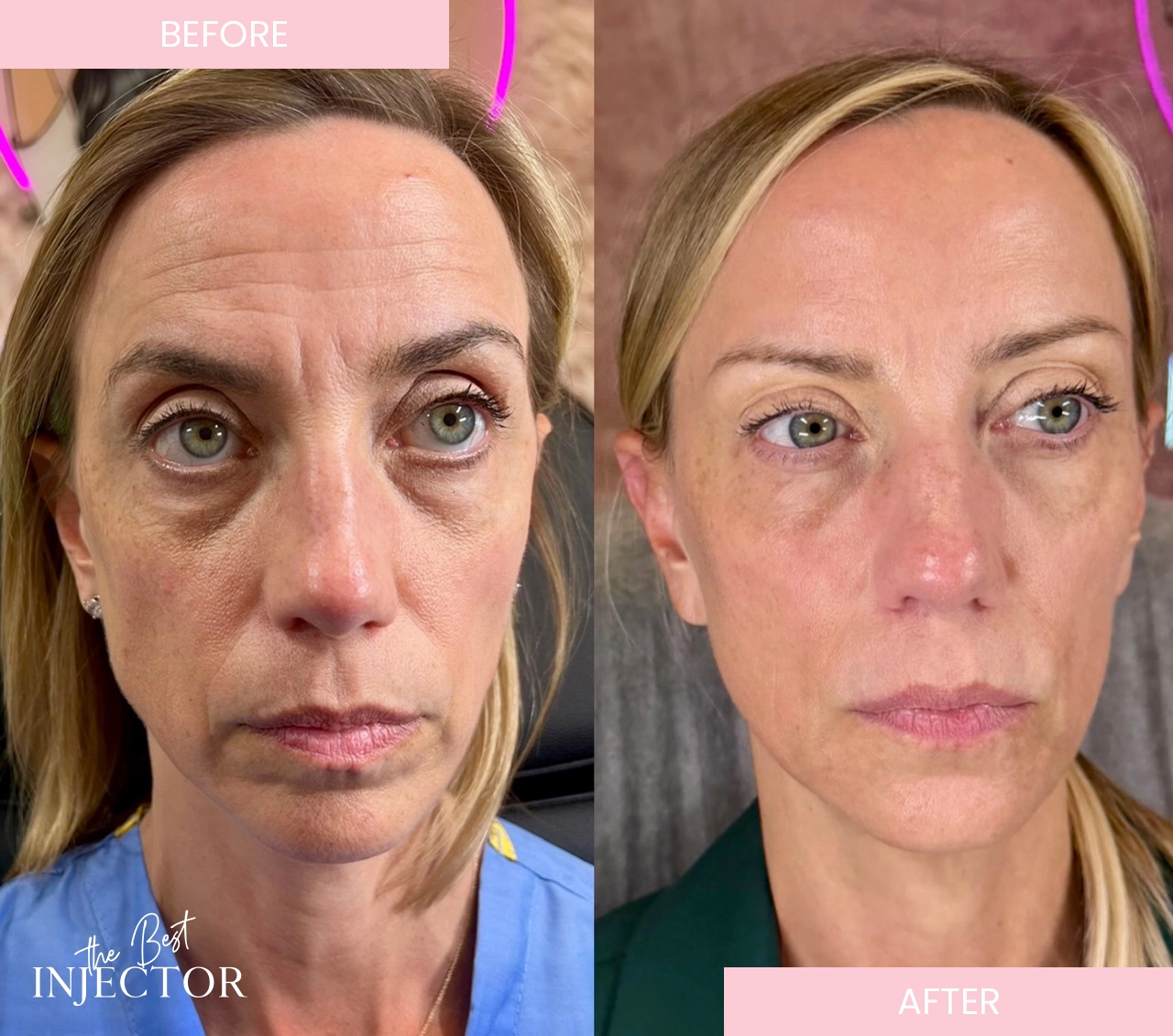 Facial Balancing-before after