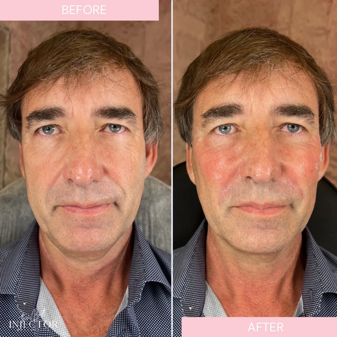 Facial balancing Delray Beach, FL a