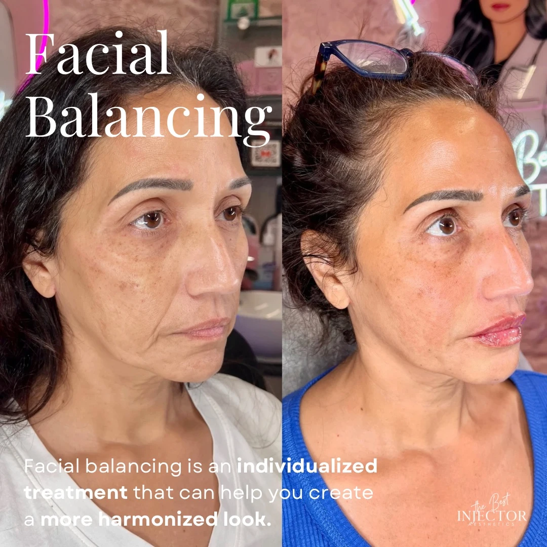 Facial balancing Delray Beach, FL