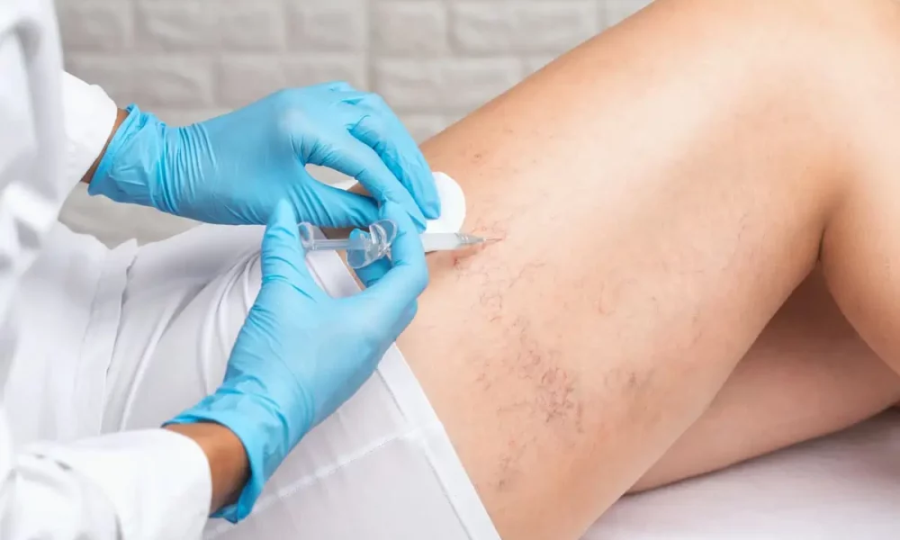 How Does Sclerotherapy Work To Address Vascular Issues