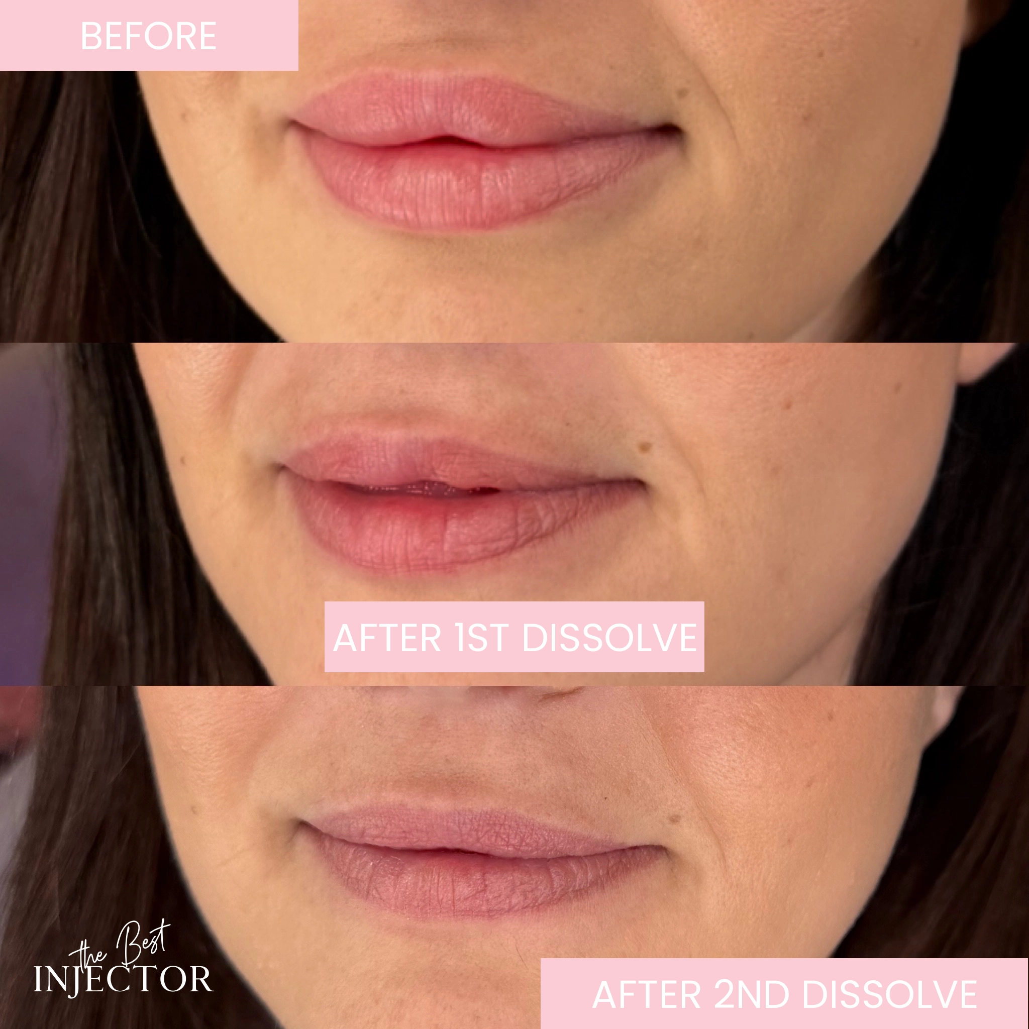 Lip Dissolve filler dissolve best injector