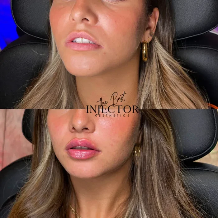 Fillers Before and Afte Eight in Delray Beach, FL at The Best Injector