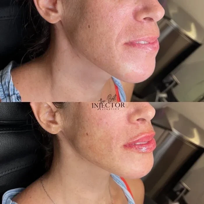Fillers Before and Afte Eleven in Delray Beach, FL at The Best Injector