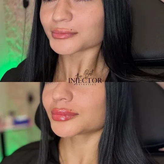 Fillers Before and Afte Fifteen in Delray Beach, FL at The Best Injector
