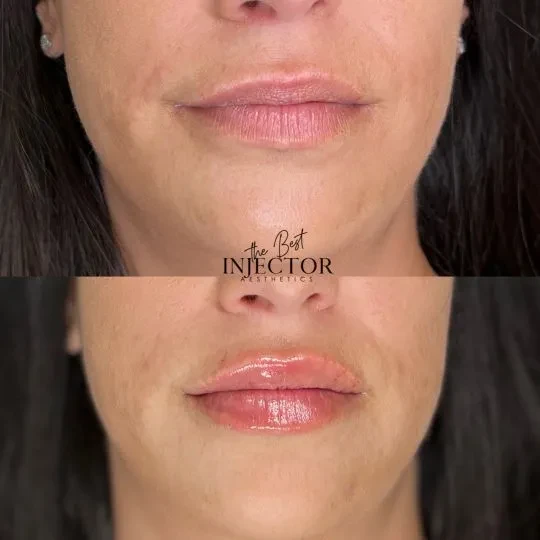 Fillers Before and Afte Forteen in Delray Beach, FL at The Best Injector