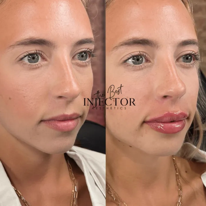 Fillers Before and Afte Fourth in Delray Beach, FL at The Best Injector