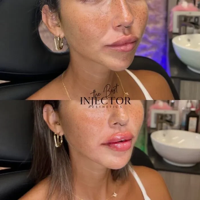 Fillers Before and Afte Nine in Delray Beach, FL at The Best Injector