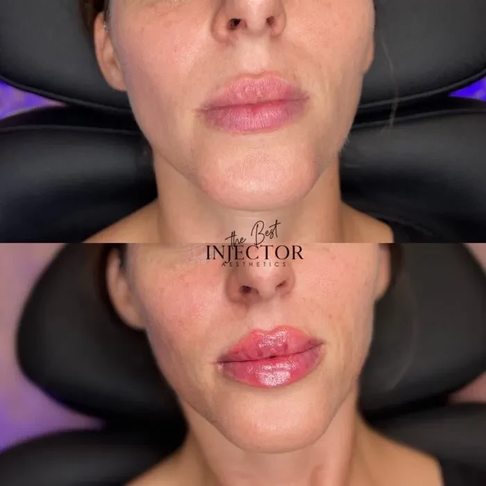 Fillers Before and Afte Seven in Delray Beach, FL at The Best Injector