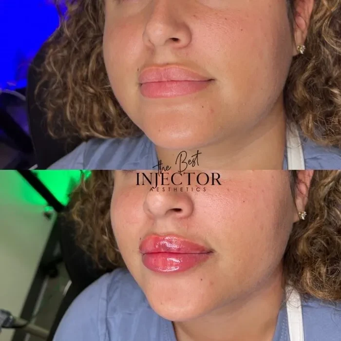 Fillers Before and Afte Six in Delray Beach, FL at The Best Injector