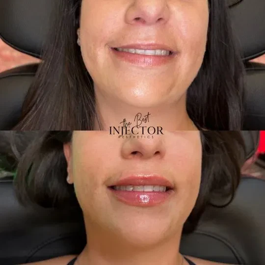 Fillers Before and Afte Sixteen in Delray Beach, FL at The Best Injector