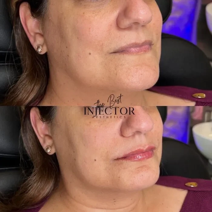 Fillers Before and Afte Ten in Delray Beach, FL at The Best Injector