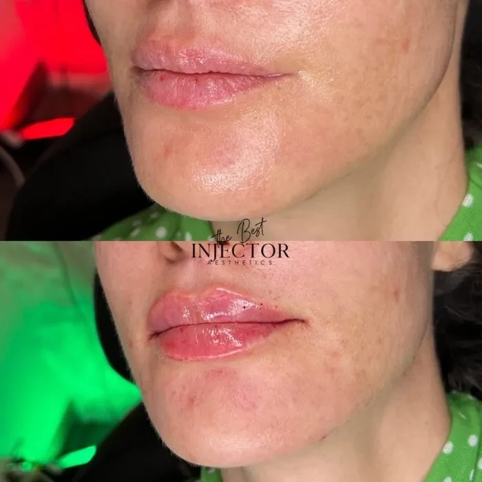 Fillers Before and Afte Thirteen in Delray Beach, FL at The Best Injector