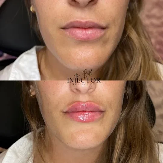 Fillers Before and Afte Twelve in Delray Beach, FL at The Best Injector