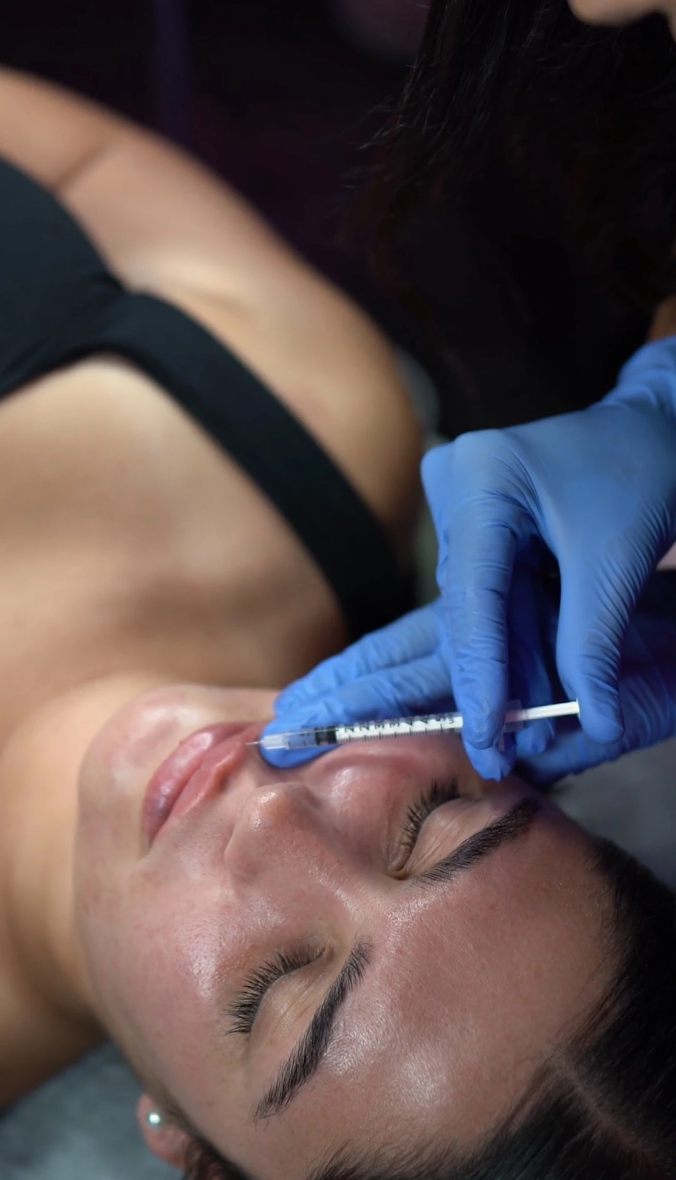 Lip augmentation Delray Beach
