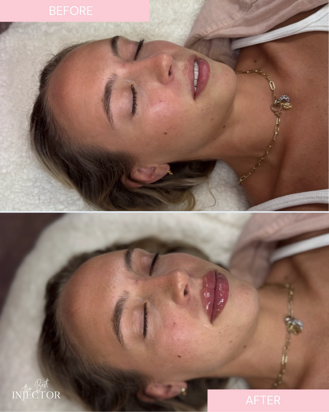 lip-fillers-before-after-by-the-best-injector-a