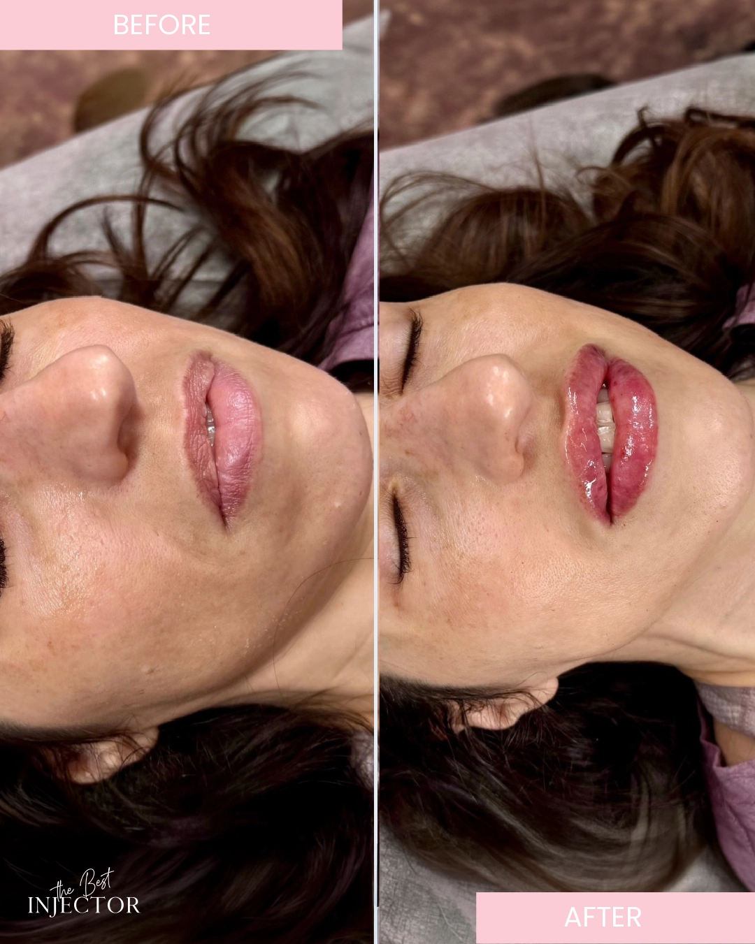 lip-fillers-before-after-by-the-best-injector-f