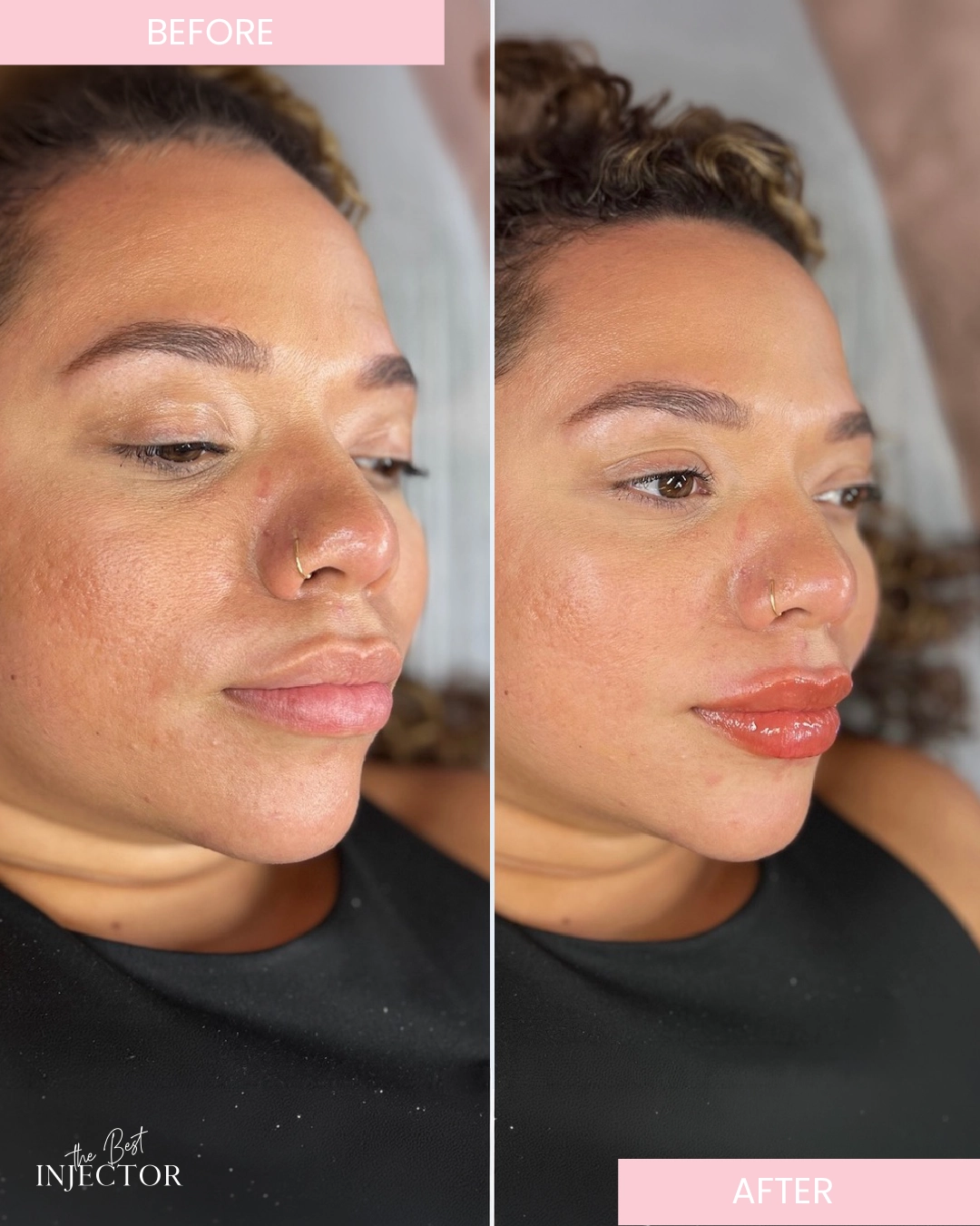 lip-fillers-before-after-by-the-best-injector-g