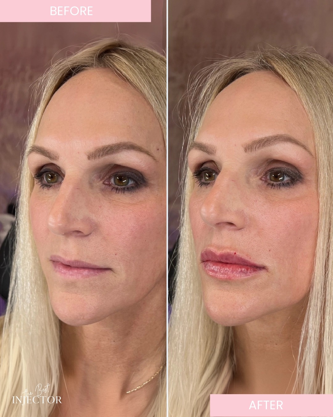 lip-fillers-before-after-by-the-best-injector-h