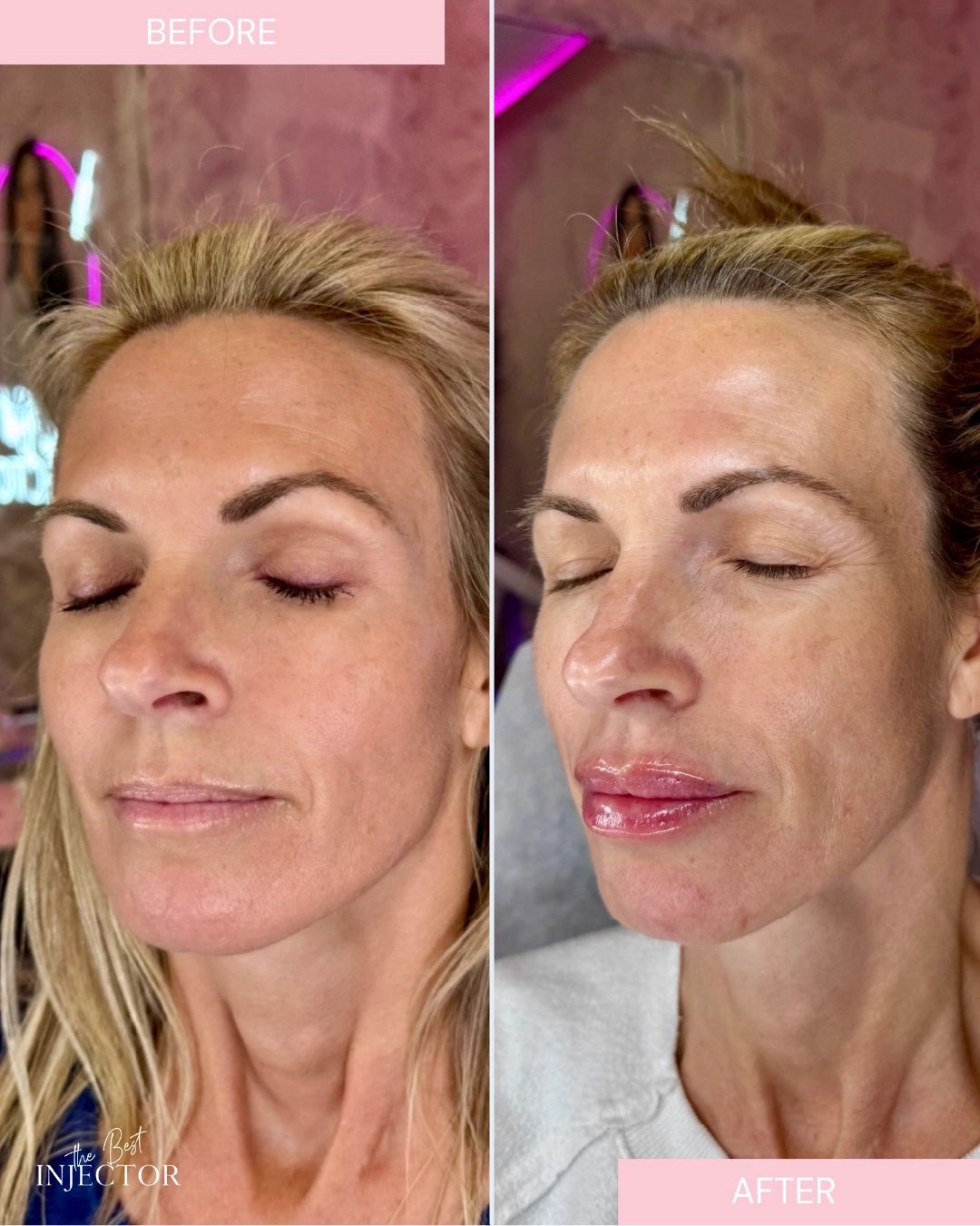 lip-fillers-before-after-by-the-best-injector-i