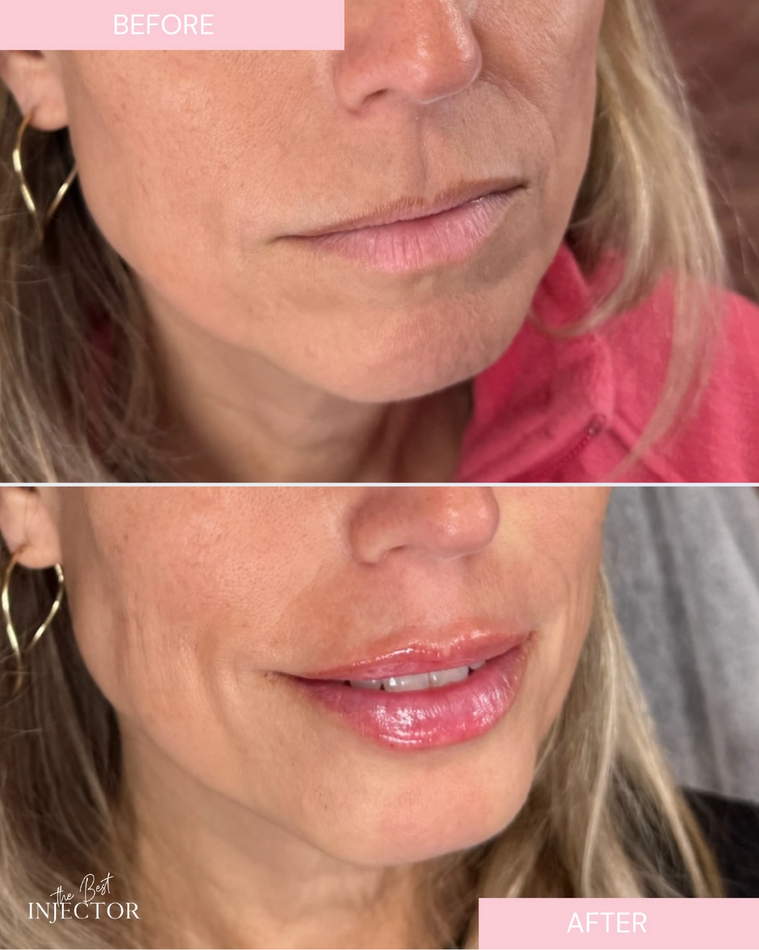 lip-fillers-before-after-by-the-best-injector-j