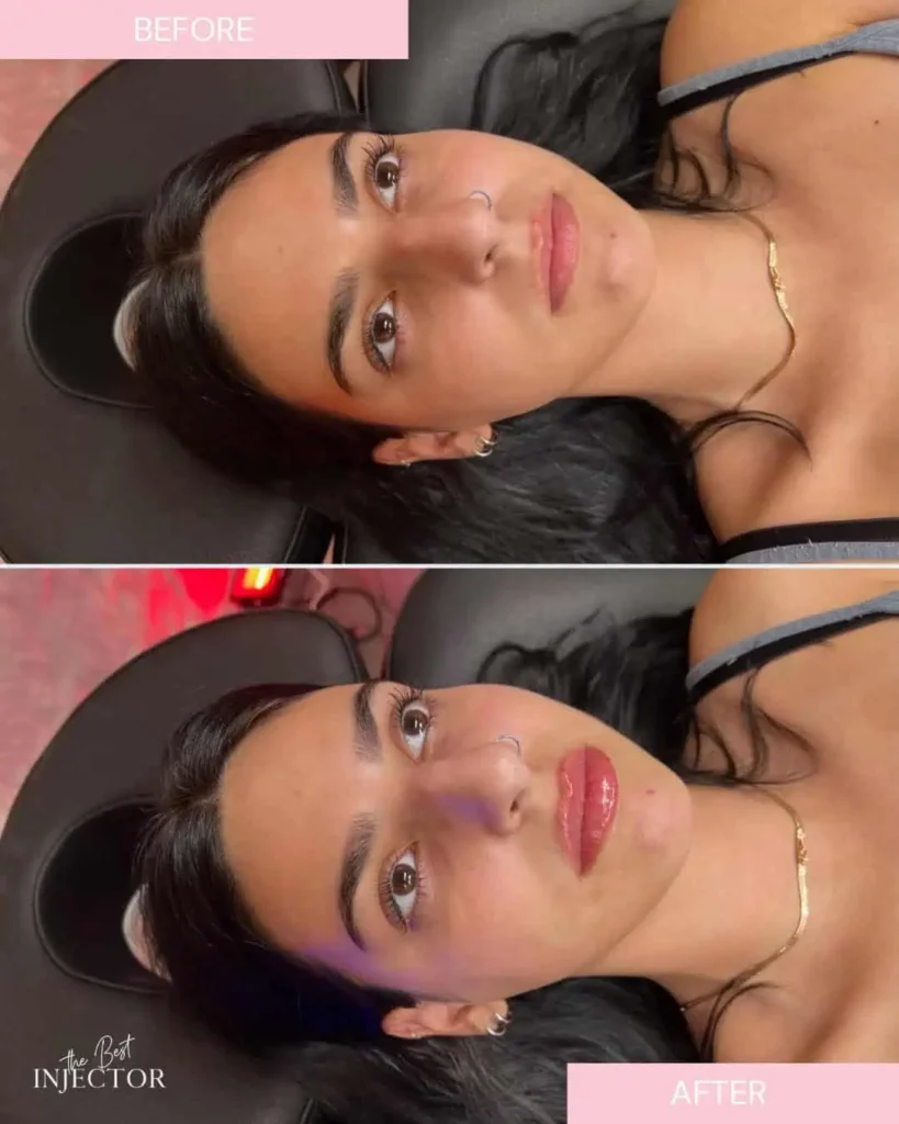 Natural lip filler before and after Delray Beach
