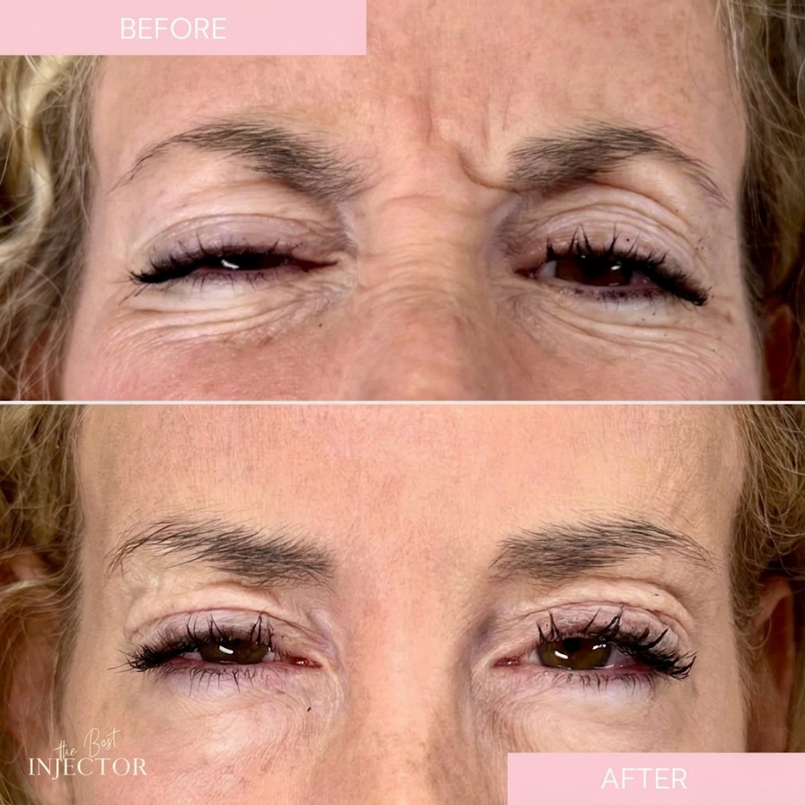 Benefits of Botox®, Dysport®, and Jeuveau®Before and After
