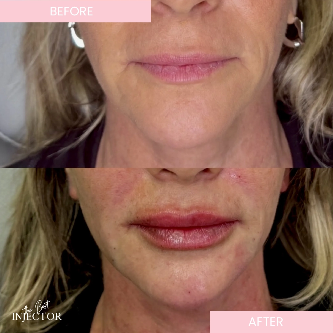 Chin-Filler (2)