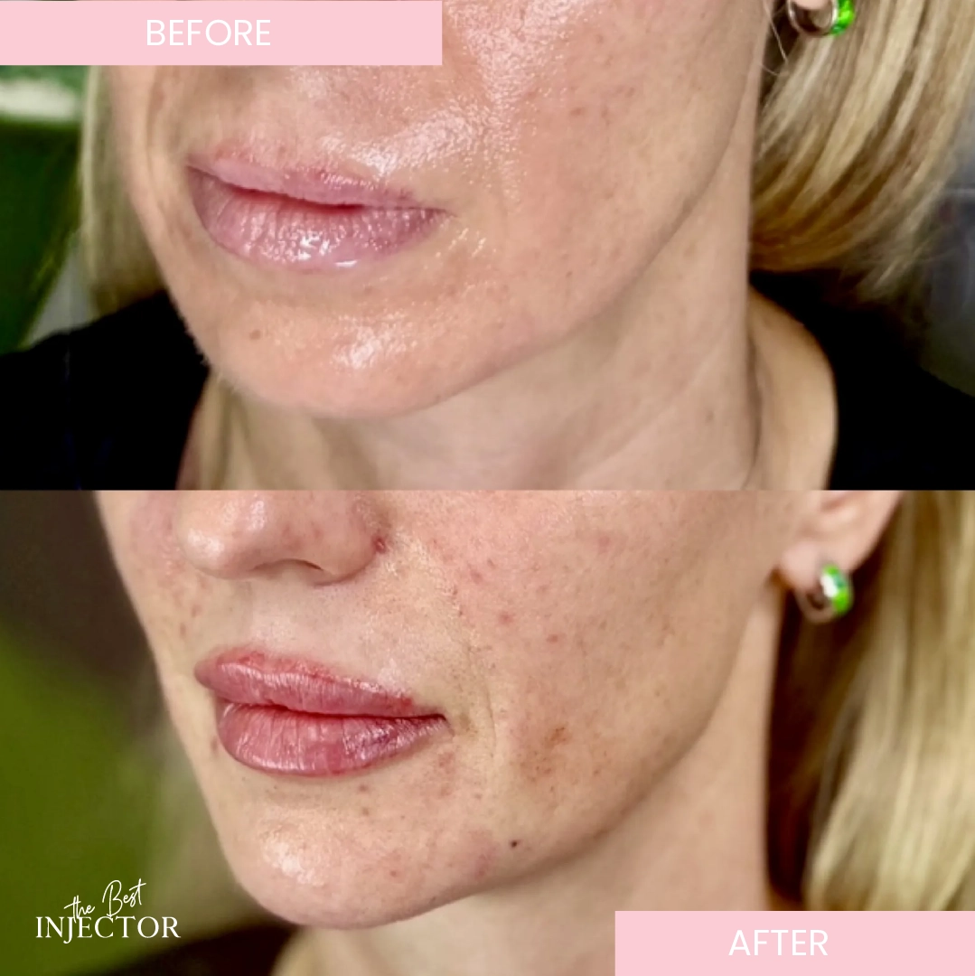 Chin-Filler (3)