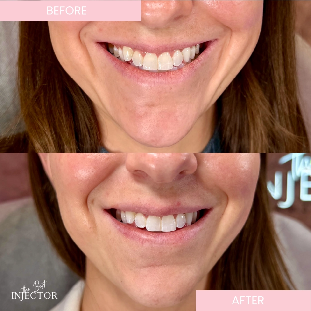 LIP FLIP IN DELRAY BEACH, FL Before after