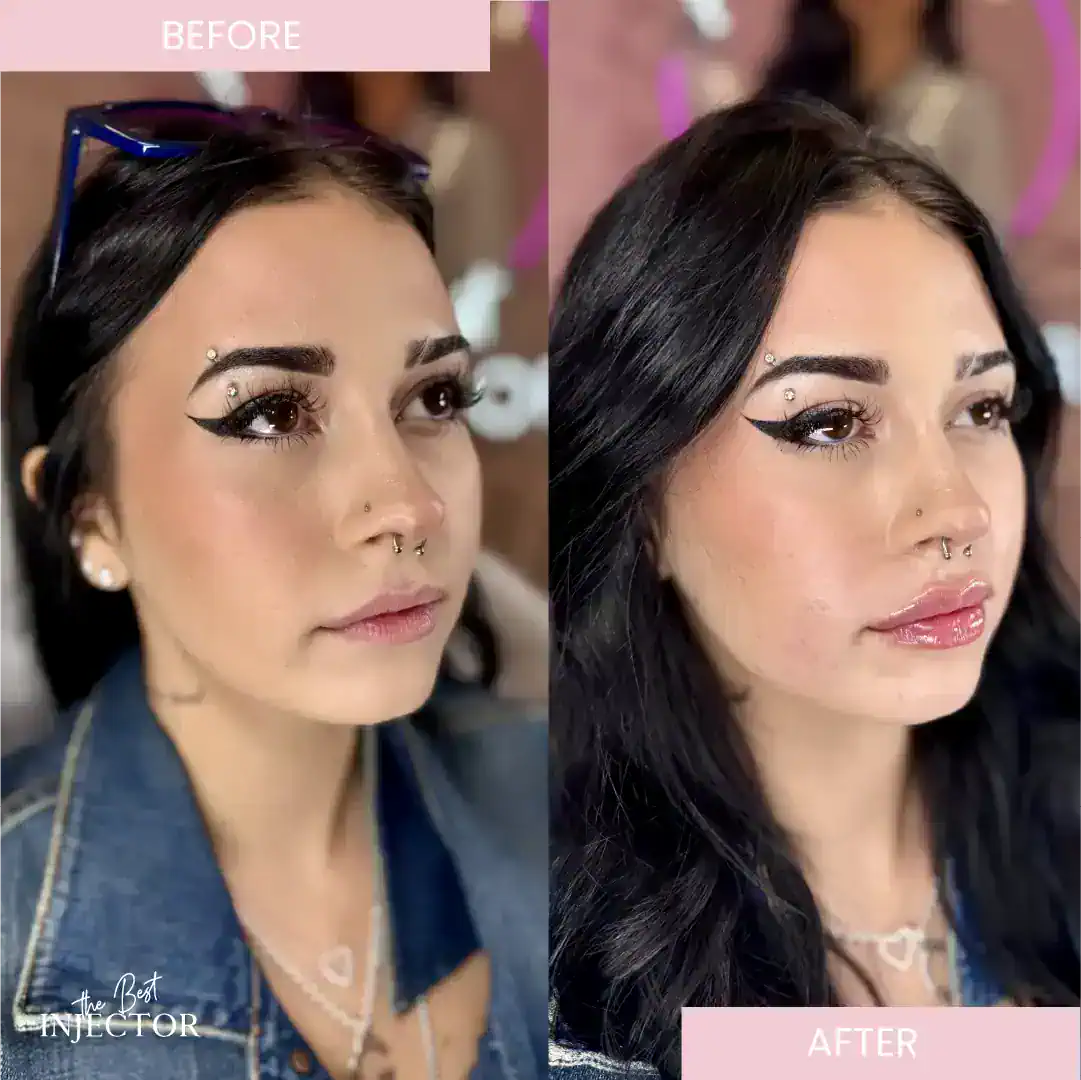 Natural lip filler before and after Delray Beach
