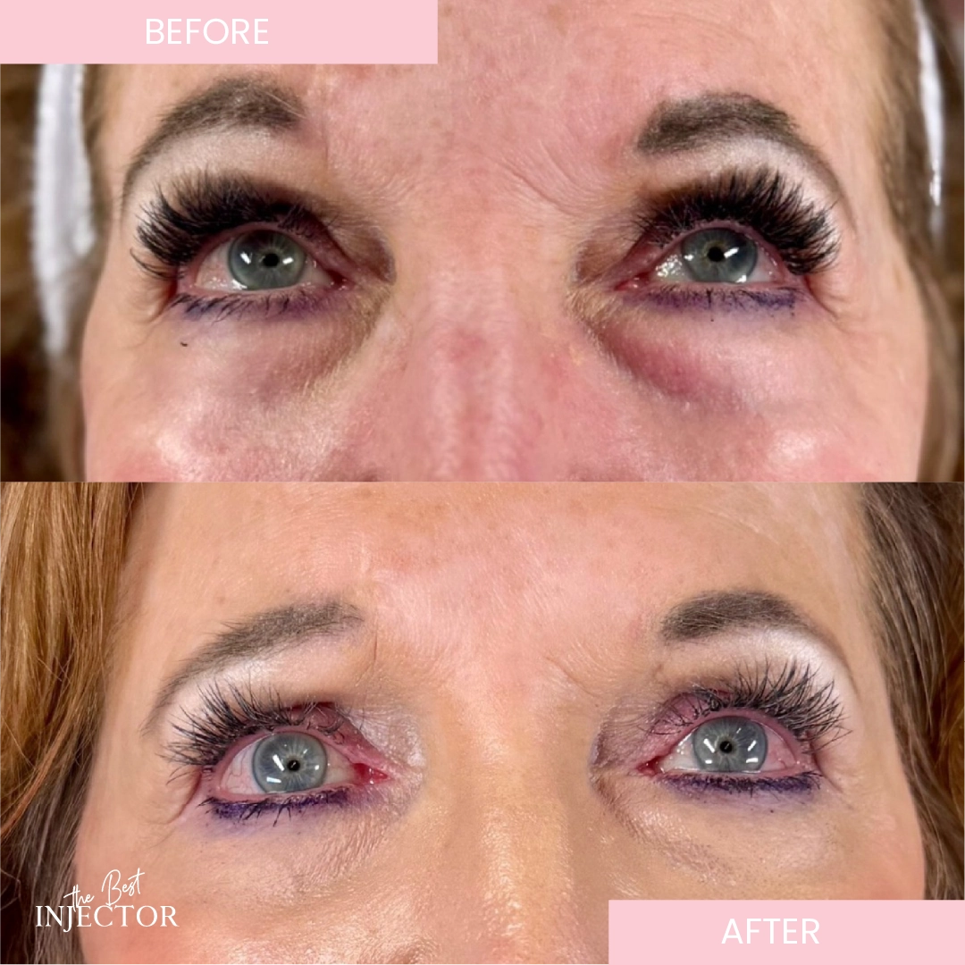 Temple Filler Before after (2)
