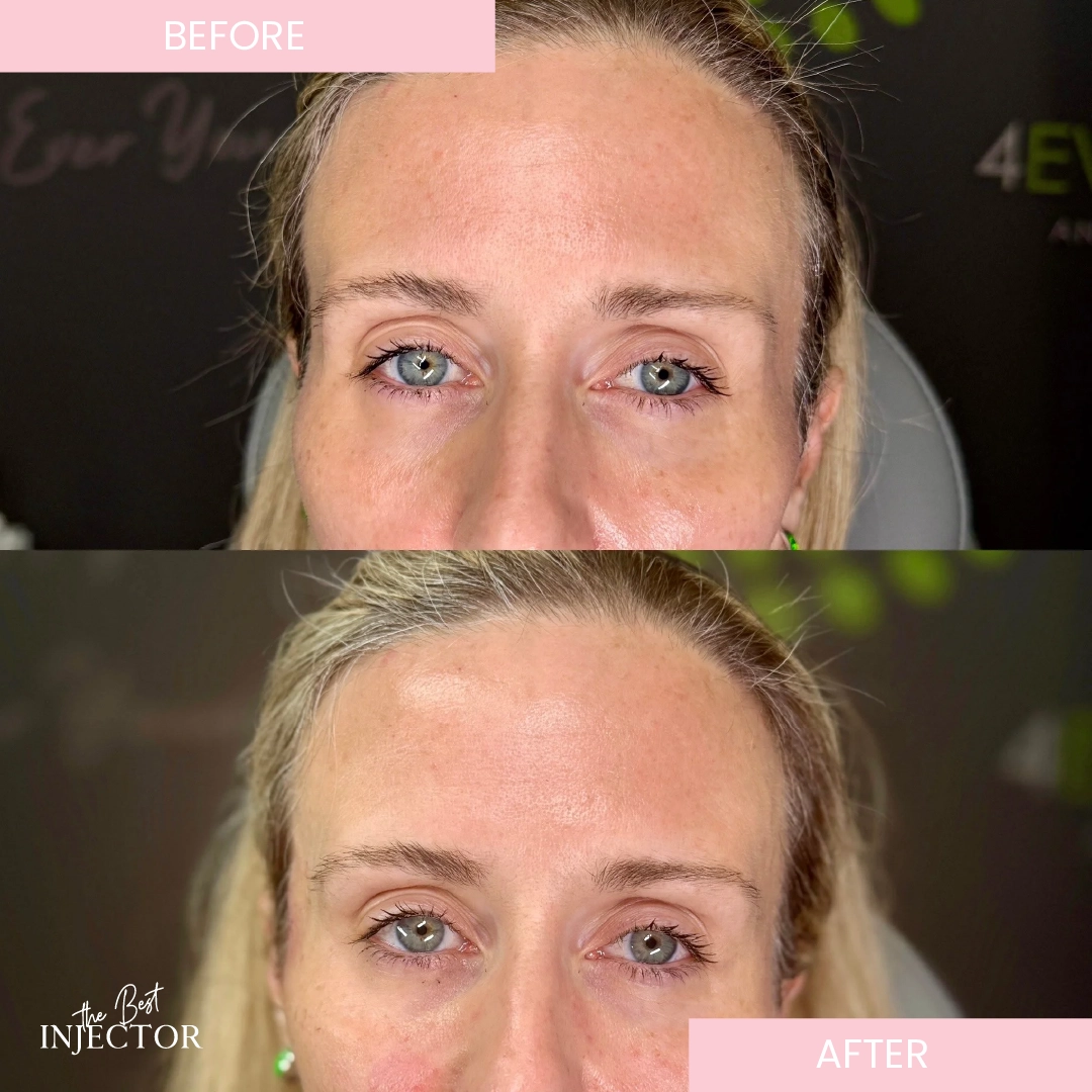 Temple Filler Before after (3)