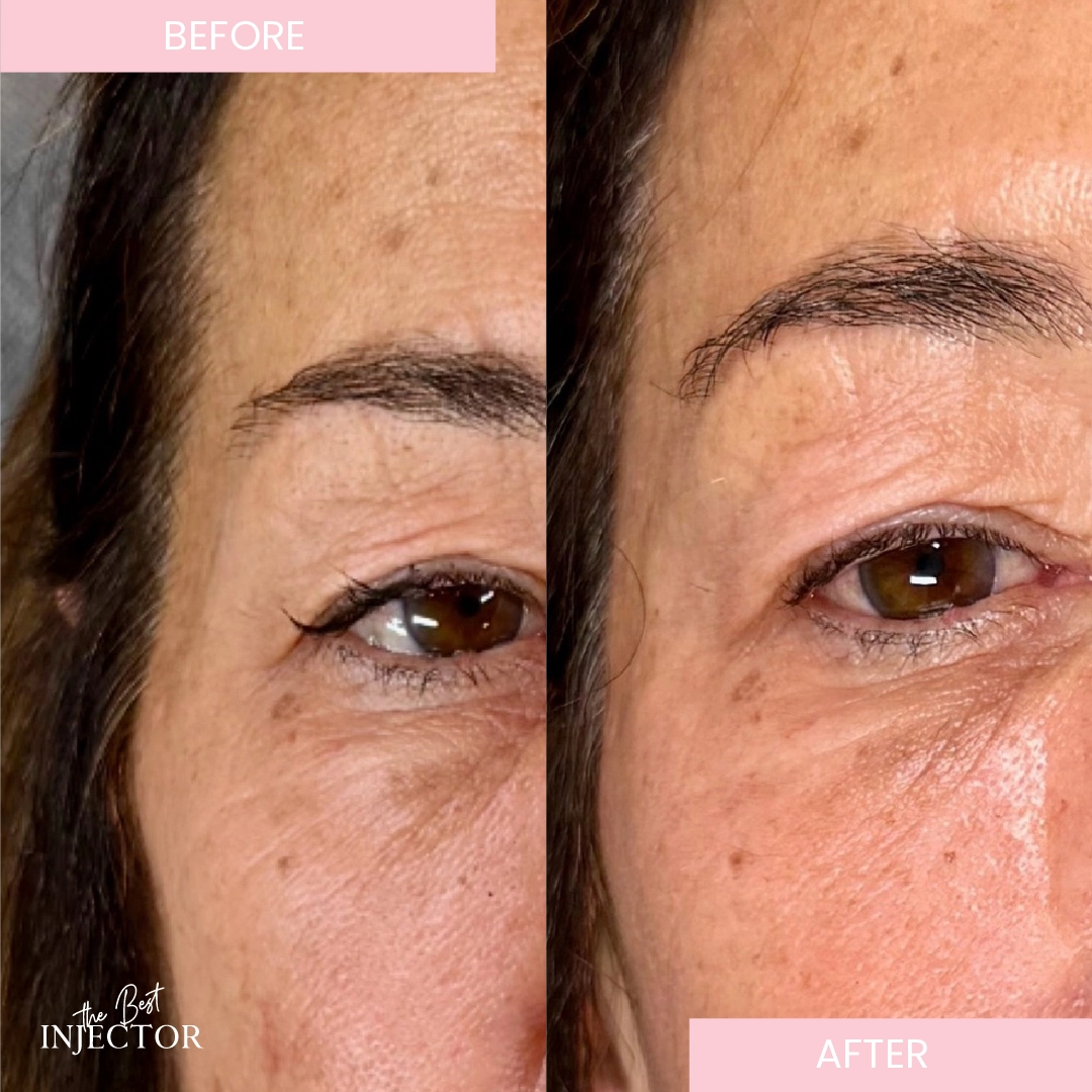 Temple Filler Before after (4)