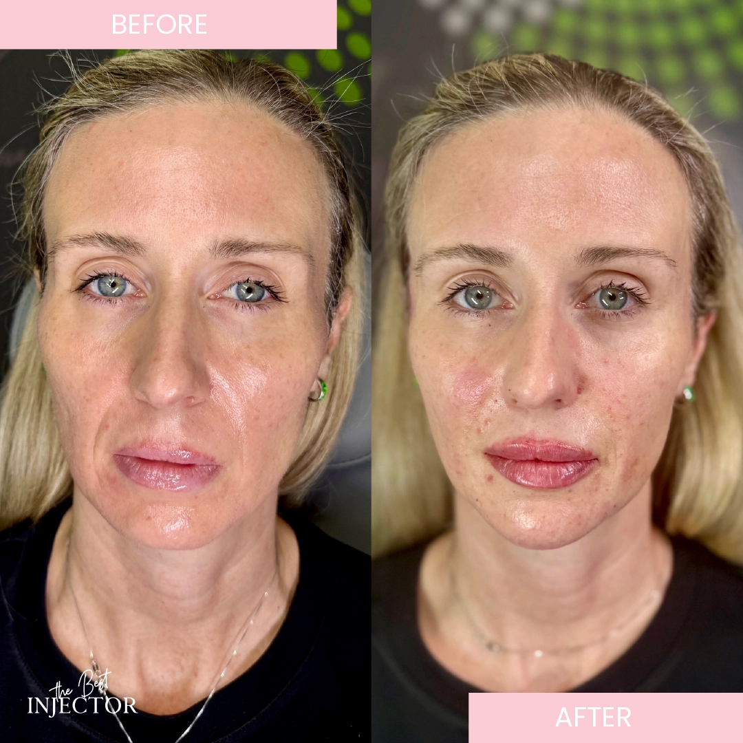 facial balancing the best injector a
