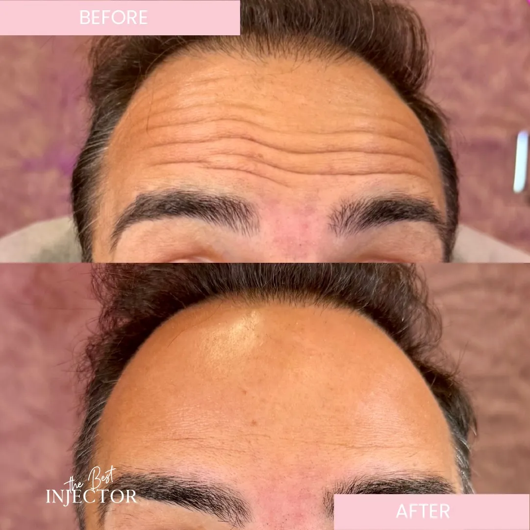 Botox Before after( bestinjector )