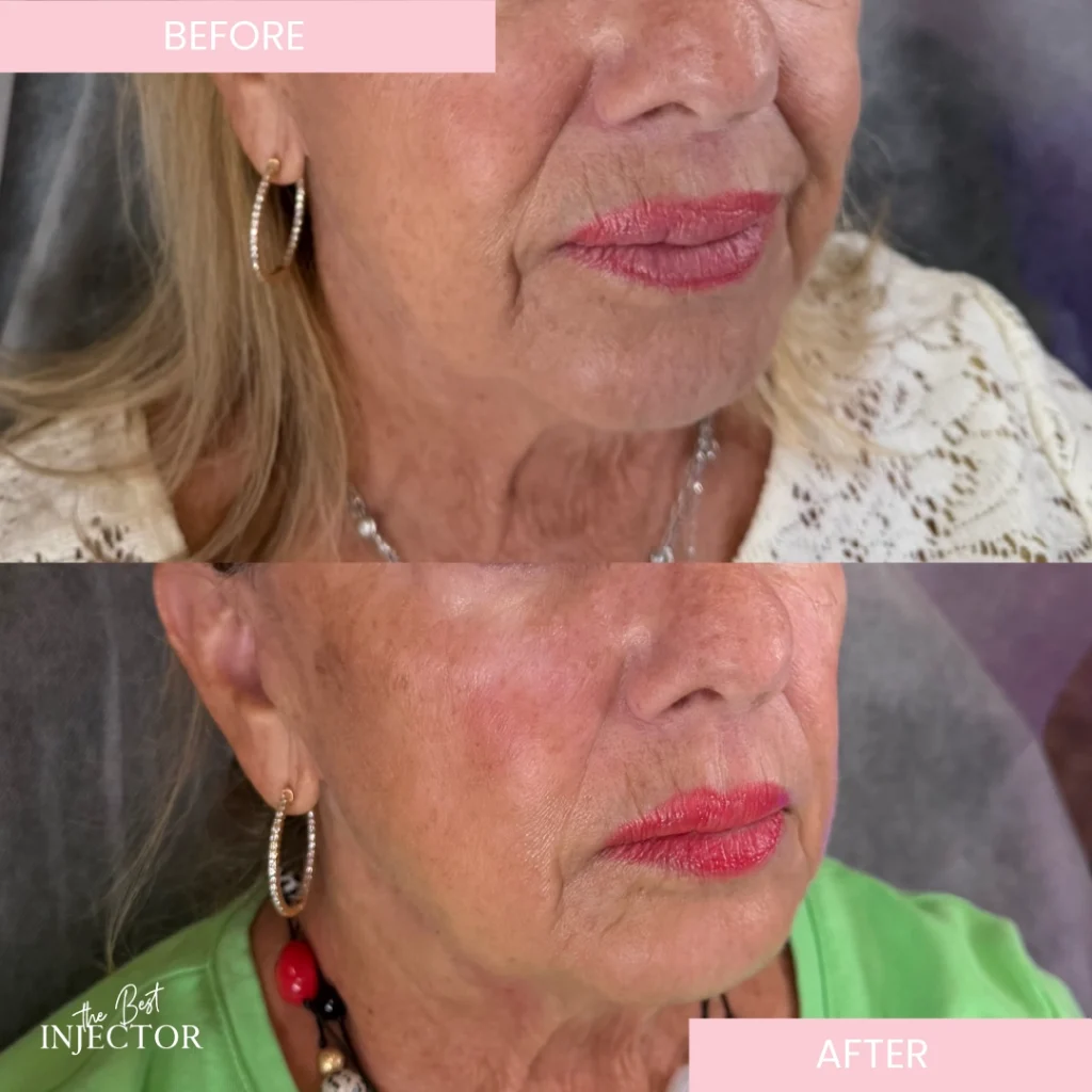 nasolabial-fold-filler-delray-beach a