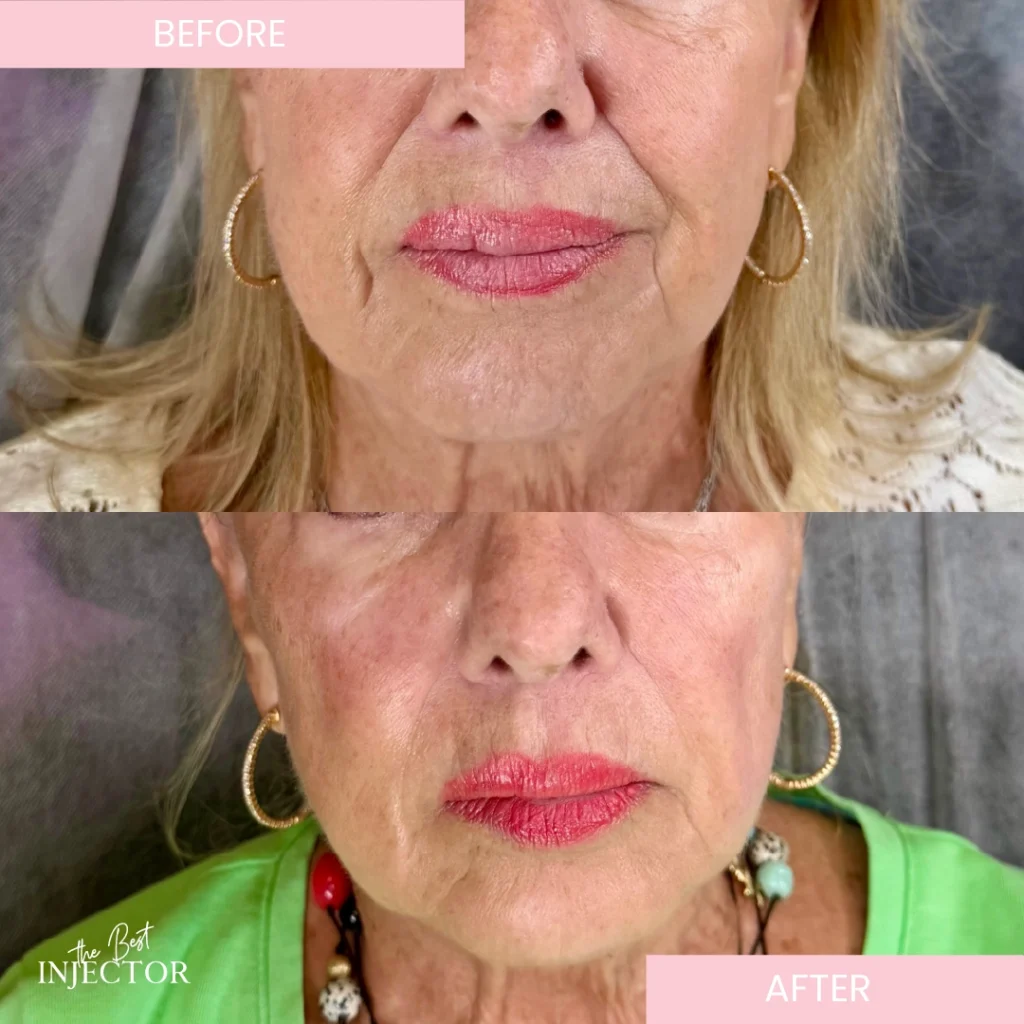 nasolabial-fold-filler-delray-beach b