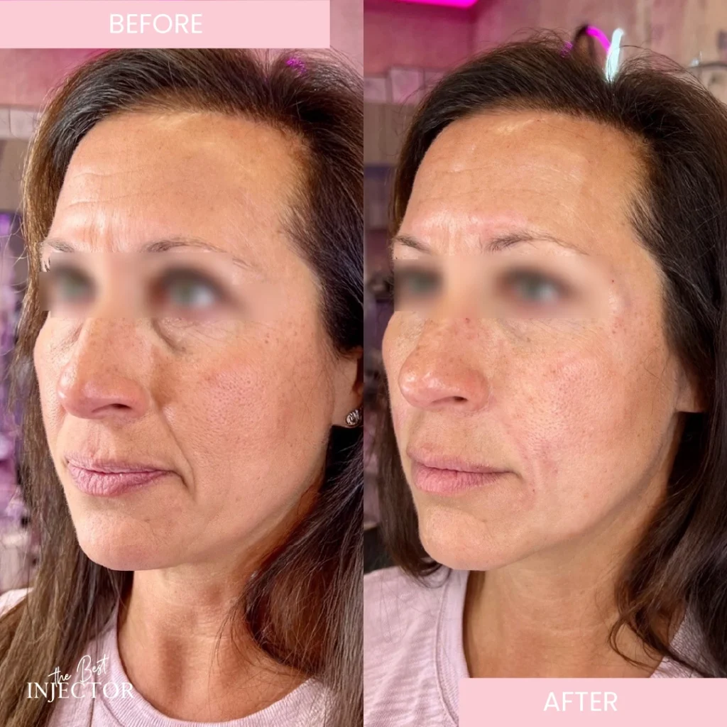 smile-line-filler-boca-raton a