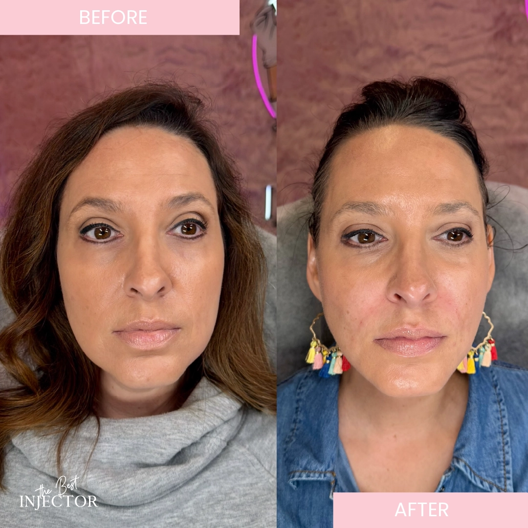 Kybella double chin injections by expert injector in Delray Beach