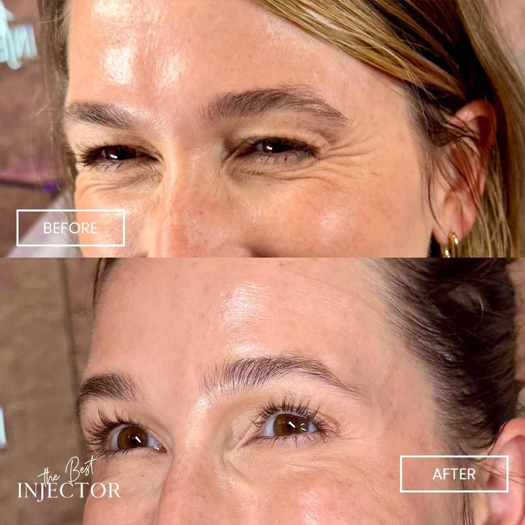 Botox_before-after (1)