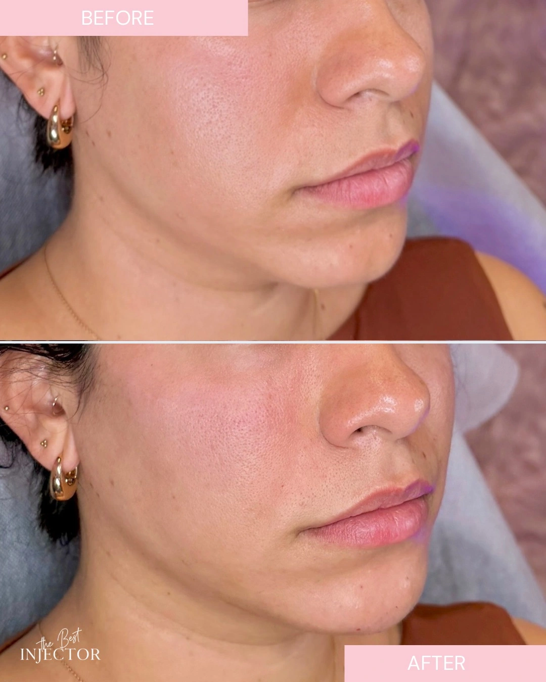 Chin Filler B&A