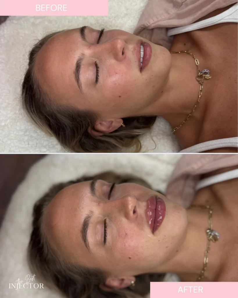 Natural lip filler before and after Delray Beach