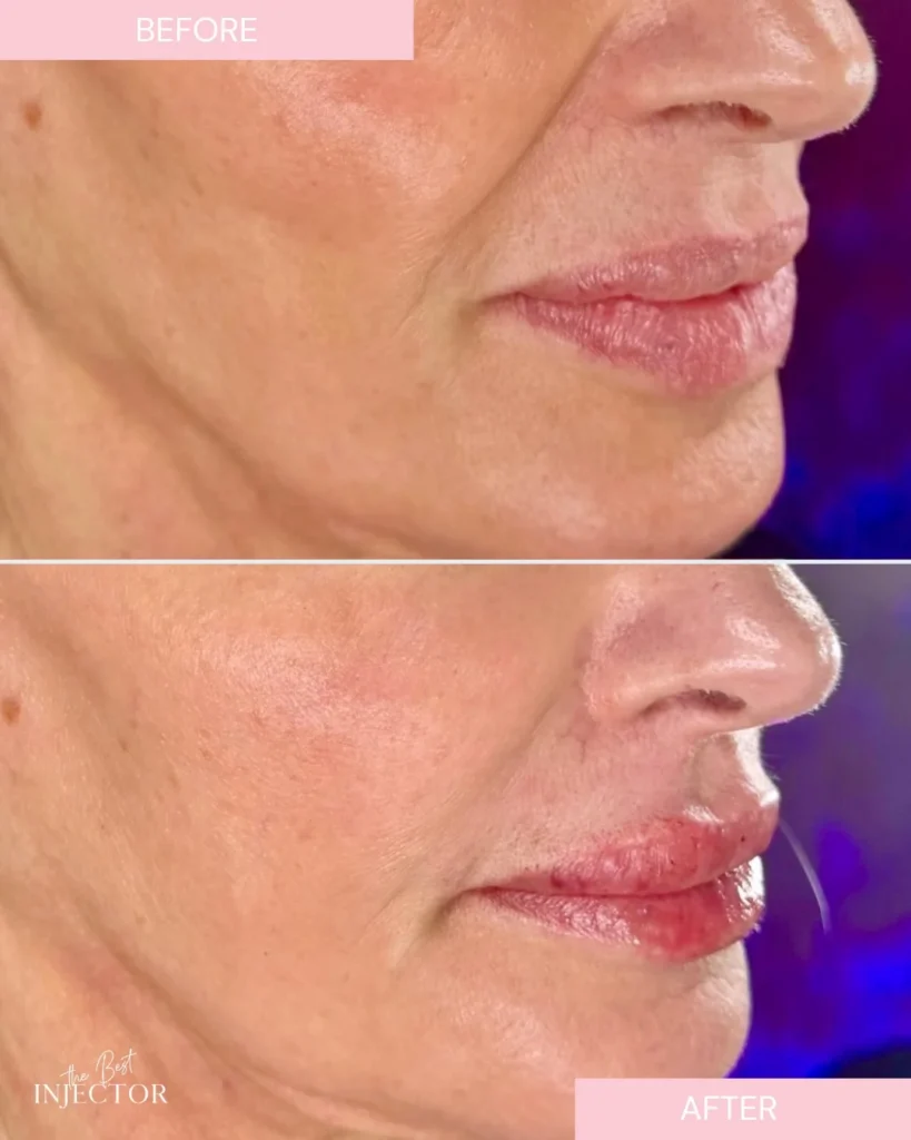 Natural lip filler before and after Delray Beach