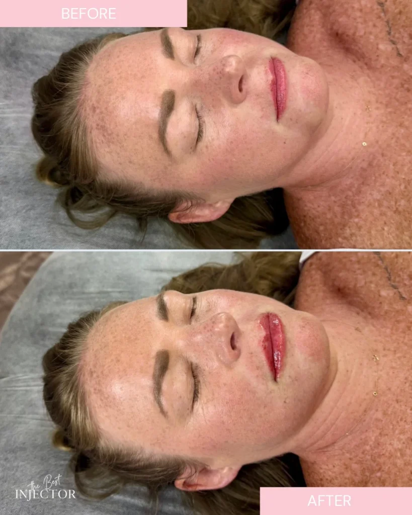 Lip filler results Delray Beach Florida